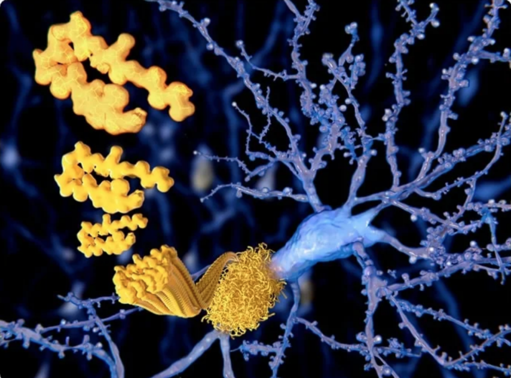 Beta-amyloide peptider, amyloid plakk som gror på en nevron.